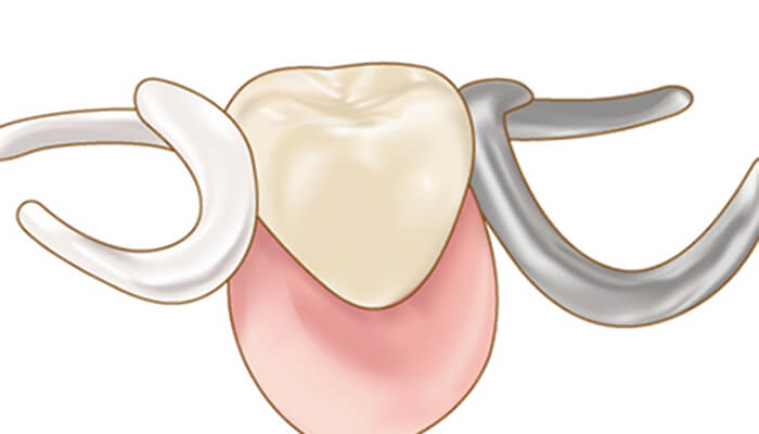 部分入れ歯