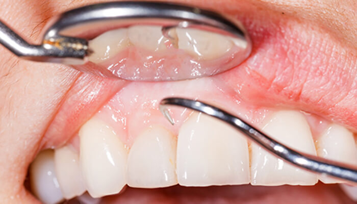 歯周病の主な原因